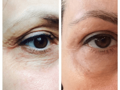 Elimina arrugas y marcas alrededor del ojo