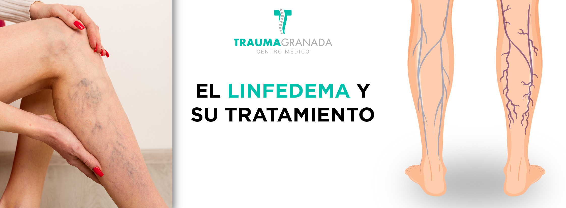 Presoterapia y Drenaje Linfático Manual, la pareja perfecta - Trauma Granada